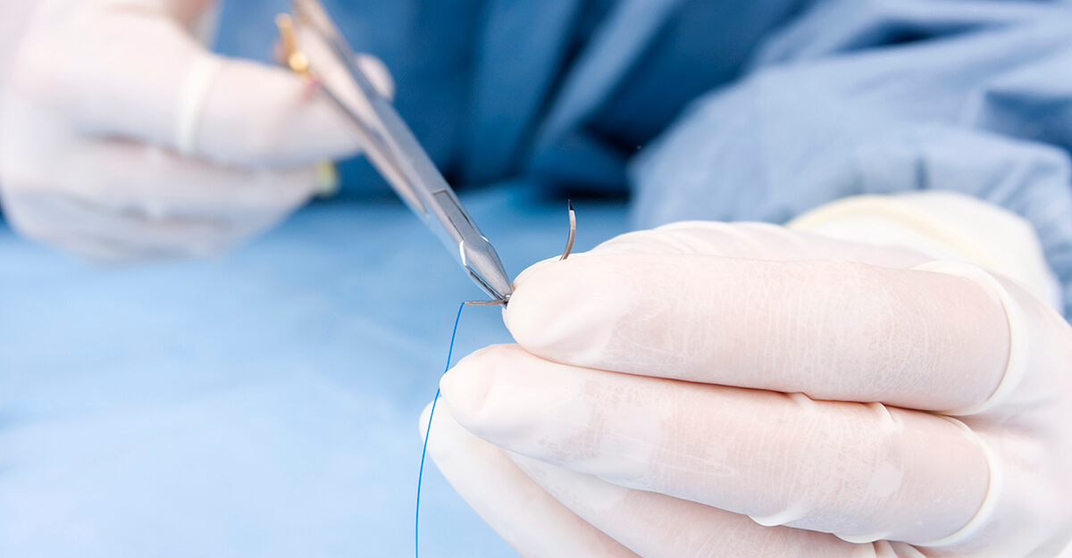 Wound Closure Suture